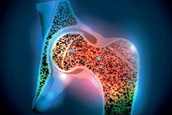 Osteoporosis Hip Joint 400