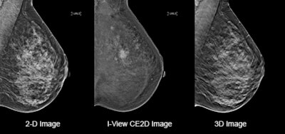 Clinical patient images comparing details available on a 2D mammography system (left) with contrast-enhanced software (center) and on a 3D mammography gantry (right). Figure courtesy of Hologic.