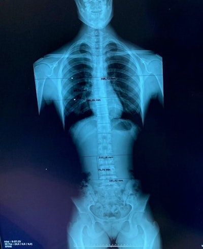 Estimated overlapping regions in the General Electric Definium 8000 unit for a patient with three projections.