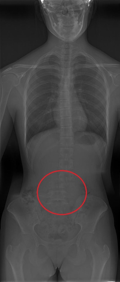 Reconstruction artifact in which a shift in part of the spine is shown. All figures courtesy of P. Garcia Castañon, S. Honorato Hernandez, C. Prieto Martin et al and ESR EPOS database.