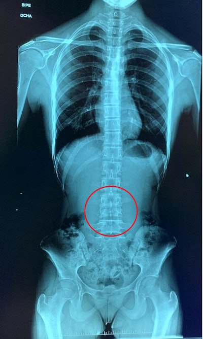 A more subtle stitching artefact is shown, where two vertebrae seem to be united.