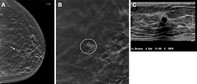 Images depict a 67-year-old woman who was recalled from screening for a small focal asymmetry in the left breast. (A) 2D mammographic image shows the lesion (arrow), which is difficult to see. (B) The digital breast tomosynthesis section image shows spiculated margins (circle). (C) The ultrasound image shows a corresponding irregular hypoechoic mass with angular margins. Pathologic evaluation revealed a 0.7-cm triple-negative invasive carcinoma. Image courtesy of RSNA.