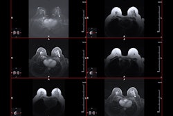 Mri Breast Cancer