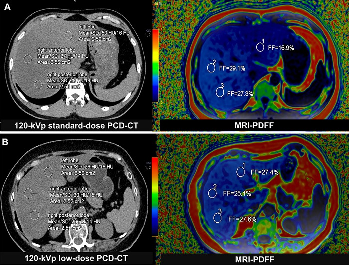 Liver fat content measurement with photon-counting CT and MRI-based proton density fat fraction (PDFF). Three regions of interest (circles) were delineated in the peripheral areas of the left, right anterior, and right posterior lobes of the liver. (A) Representative axial unenhanced 120-kVp standard-dose CT image (left) and corresponding MRI scan (right) in a 33-year-old man (body mass index, 26.2) diagnosed with metabolic dysfunction-associated steatotic liver disease (MASLD) in the asymptomatic cohort. (B) Representative axial unenhanced 120-kVp low-dose CT image (left) and corresponding MRI scan (right) in a 69-year-old woman (body mass index, 24.6) in the MASLD cohort. Body mass index was calculated as weight in kilograms divided by height in meters squared.