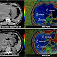 Liver fat content measurement with photon-counting CT and MRI-based proton density fat fraction (PDFF). Three regions of interest (circles) were delineated in the peripheral areas of the left, right anterior, and right posterior lobes of the liver. (A) Representative axial unenhanced 120-kVp standard-dose CT image (left) and corresponding MRI scan (right) in a 33-year-old man (body mass index, 26.2) diagnosed with metabolic dysfunction-associated steatotic liver disease (MASLD) in the asymptomatic cohort. (B) Representative axial unenhanced 120-kVp low-dose CT image (left) and corresponding MRI scan (right) in a 69-year-old woman (body mass index, 24.6) in the MASLD cohort. Body mass index was calculated as weight in kilograms divided by height in meters squared.