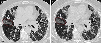 Chest CT in the craniocaudal direction at inspiration in a 62-year-old male participant with a combination of obstructive and restrictive chronic lung allograft dysfunction one year after lung transplant due to fibrosis. (A) Standard-of-care low-dose (LD) image (effective dose, 1.77 mSv) and (B) ultralow-dose (ULD1) image (effective dose, 0.307 mSv) show a comparison of image quality between protocols. Peripheral vessels (white arrows), bronchiectasis (black arrows), ground-glass opacity (red circles), and small consolidations (arrowheads) seen on the LD image (A) have excellent visualization on the ULD1 image (B), which was acquired with a target effective dose of approximately 20% of the LD protocol. The subjective image quality scores of the ULD1 image were 4, 4, and 3.