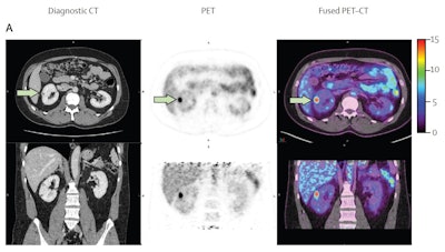 A 40-year-old male with 12 mm lesion in superior right kidney showing positive Zr-89 girentuximab PET and histologically confirmed clear-cell renal cell carcinoma.