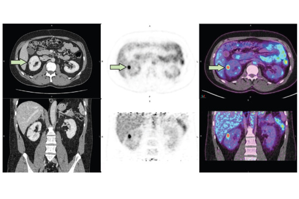 Pet Renal Cancer 66e1e00428375 Thumbnail