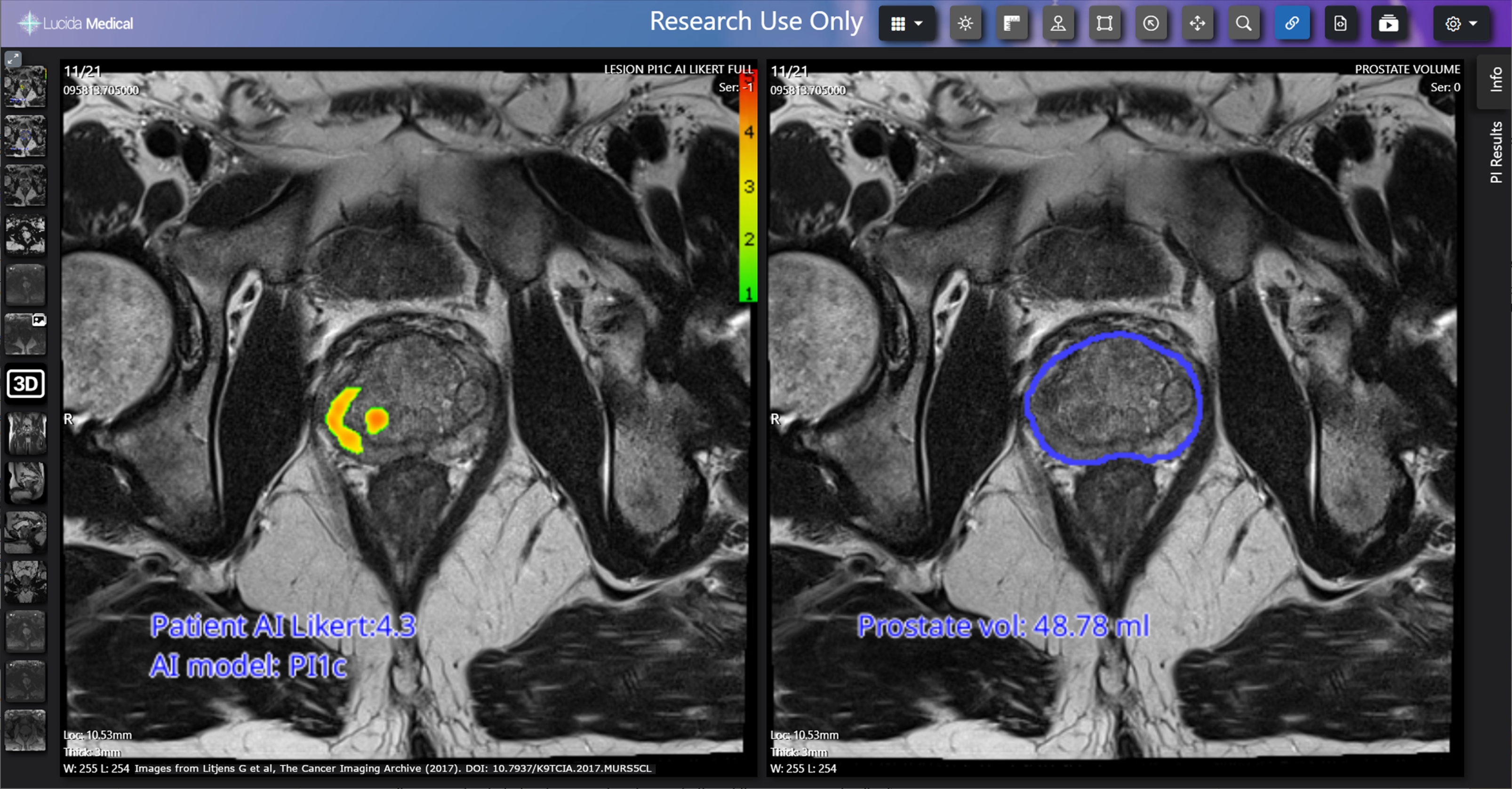 Prostate Cancer Found By Pi