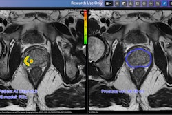 Prostate Cancer Found By Pi