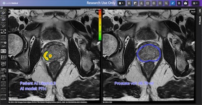 Prostate Cancer Found By Pi