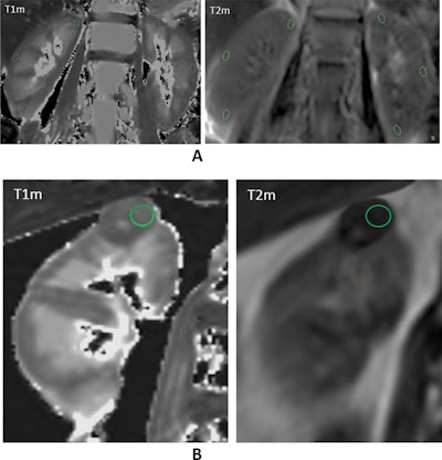 Examples of native T1 and T2 mapping in the reference group and renal mass cohorts with region of interest (ROI) delineation. A: Native T1 mapping (left) and T2 mapping (right) coronal raw images of normal kidneys. Three oval ROIs measuring 0.30cm2 were manually drawn at the same symmetrical location of the left and right kidneys, including the superior, middle, and inferior pole of the cortex. B: Native T1 mapping (left) and T2 mapping (right) coronal image of an oncocytoma of the upper pole of the right kidney (maximum diameter: 3 cm). A freehand circular ROI in the tissue part of the mass was set at 1.0cm2.