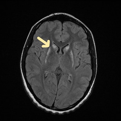 Organophosphate poisoning. Axial MRI scan shows fluid-attenuated inversion recovery (FLAIR) hyperintensity in caudate and lentiform nucleus of brain.