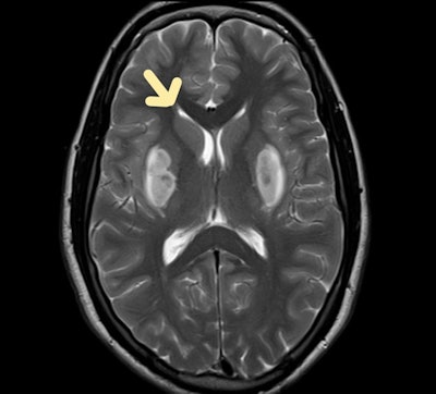 Methanol poisoning. Bilateral putaminal hyperintensities are visible on T2-weighted axial MRI scan of the brain.