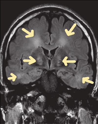 Carbon monoxide poisoning. Brain MRI scan (coronal FLAIR sequence) shows symmetric hyperintense foci in the globus pallidus.