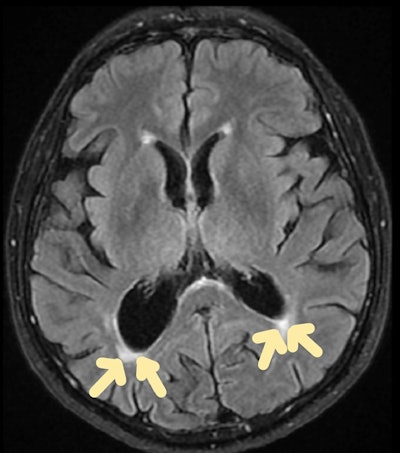 Carbon monoxide poisoning. Brain MRI scan (axial FLAIR sequence) shows periventricular hyperintensities. All images courtesy of Dr Gurubharath Ilangovan et al and the ESR's EPOS database.