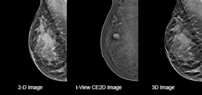 Clinical images comparing results from the same patient taken on a 2D mammography system (left), using contrast-enhanced software (center), and on a 3D mammography gantry (right). Figure courtesy of Hologic.