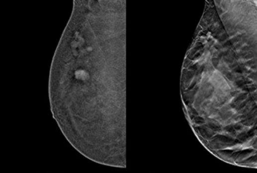 2024 10 18 Mammography Comparison Clinical Images Thumbnail