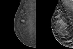 2024 10 18 Mammography Comparison Clinical Images Thumbnail