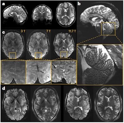 In vivo images of the human brain obtained at 11.7T. (A) In vivo 3D T2 variable flip angle turbo spin-echo acquisition at 11.7T with parallel transmission GRAPE universal pulses (resolution 0.55 × 0.55 × 0.55 mm3, acquisition time 13 min) demonstrating the high B1+ (RF) field homogeneity reached throughout the whole brain volume. (B) In vivo T2*-weighted 2D GRE sagittal slice (resolution 0.2 × 0.2 × 1 mm3, acquisition time 8 min 30 s). (C) T2* weighted 2D GRE axial images acquired at 3T (left), 7T (middle) and 11.7T (right) with identical acquisition times (4 min 17 s), while keeping similar contrast-to-noise ratio through adjusted acquisition parameters (FA (°), TR (ms) and TE (ms) of 27, 750 and 45; 34, 950 and 25; 27, 600 and 20 at 3, 7 and 11.7T, respectively) and spatial resolution (0.5, 0.325 and 0.2-mm in-plane resolution for 3, 7 and 11.7T, respectively, 1-mm thickness). (D) The 11.7T T2*-weighted 2D GRE axial images (resolution 0.19 × 0.19 × 1 mm3, acquisition time 5 min 16 s) juxtaposed to turbo spin-echo T2-weighted images (resolution 0.3 × 0.3 × 1 mm3, acquisition time 4 min 26 s). All figures courtesy of Nicolas Boulant, PhD, et al and Nature Methods.