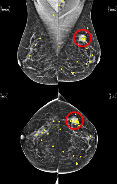 Mammograms depict a 54-year-old woman with an invasive ductal carcinoma in the lateral upper quadrant of the left breast. The yellow dots represent eye fixations, and the red circle represents the lesion region. Image courtesy of the RSNA.