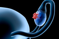 Ovarian Cancer
