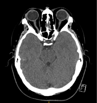In this example of an incidental finding not being communicated to the patient's GP, a patient in their 30s presented to the emergency department with sudden onset of syncope and associated head injury. After a brain and cervical spine CT, the radiologist documented incidental moderate bilateral internal carotid artery calcification. All figures courtesy of Dr. Chester Yeung et al and presented at RANZCR's 2024 ASM.
