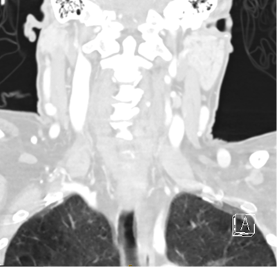 Another example of an incidental finding not being communicated to the patient's GP. CT cervical spine coronal reconstruction for a patient in their 50s who presented to the emergency department after syncope with head injury. The radiologist documented incidental emphysematous changes within the lung fields that were captured on a brain and cervical spine CT. This patient was a current smoker who had had no previous investigation, diagnoses, or treatment for chronic obstructive pulmonary disease (COPD).