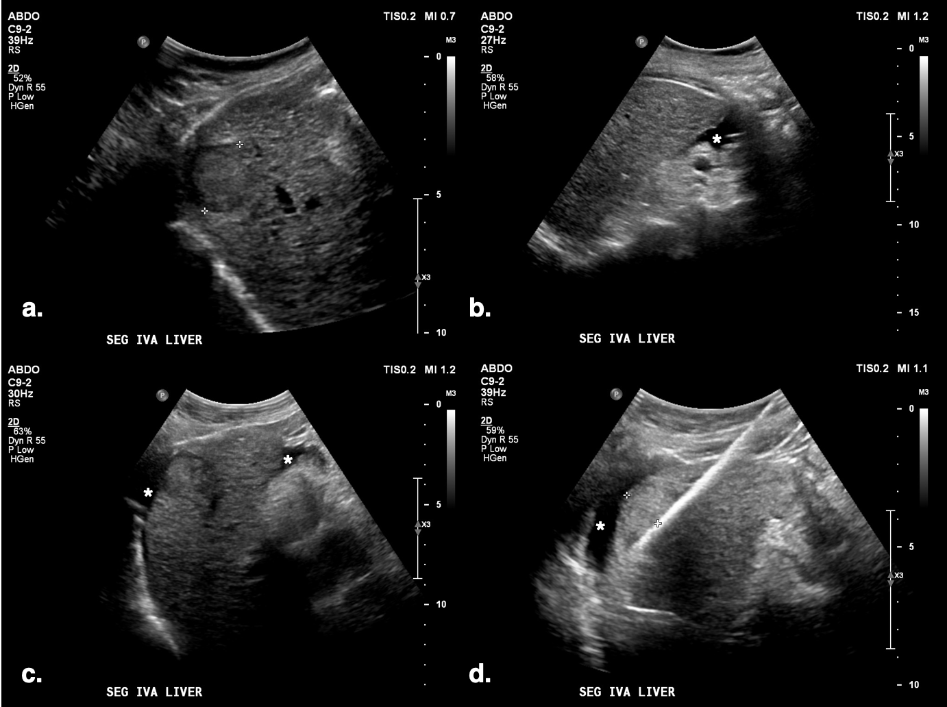 (A) Targeted HCC in segment IV-A near the diaphragm. (B) Artificial ascites (*) created using a 6.3 Fr Dawson-Mueller catheter inserted along the inferior margin of the left hepatic lobe. (C) Satisfactory distribution of ascites beneath the diaphragm. (D) Microwave antenna inserted at the target, with mechanical leveraging performed to further accentuate the gap between the liver and diaphragm.