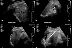 (A) Targeted HCC in segment IV-A near the diaphragm. (B) Artificial ascites (*) created using a 6.3 Fr Dawson-Mueller catheter inserted along the inferior margin of the left hepatic lobe. (C) Satisfactory distribution of ascites beneath the diaphragm. (D) Microwave antenna inserted at the target, with mechanical leveraging performed to further accentuate the gap between the liver and diaphragm.