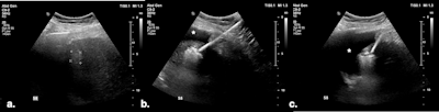 (A) Targeted HCC in segment VIII. (B) Microwave ablation in progress, with artificial ascites (*) separating the liver from the diaphragm. (C) Oblique image compared with the previous one, showing further liver displacement from the diaphragm through mechanical leveraging and illustrating continuous monitoring of the ablation zone. All figures courtesy of Dr. Bruno Di Muzio and Department of Radiology, Alfred Health, Melbourne, and presented at RANZCR's 2024 ASM.