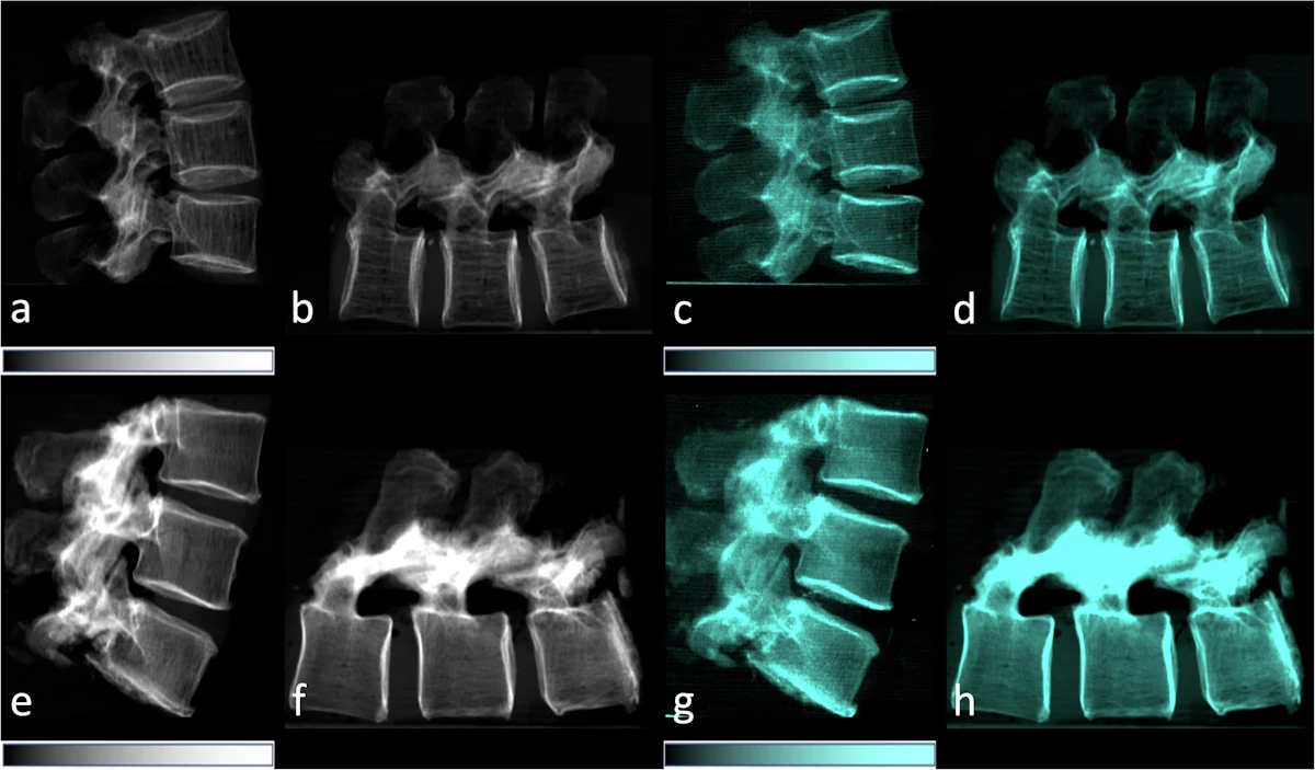 Dark-field x-ray detects bone changes related to osteoporosis ...