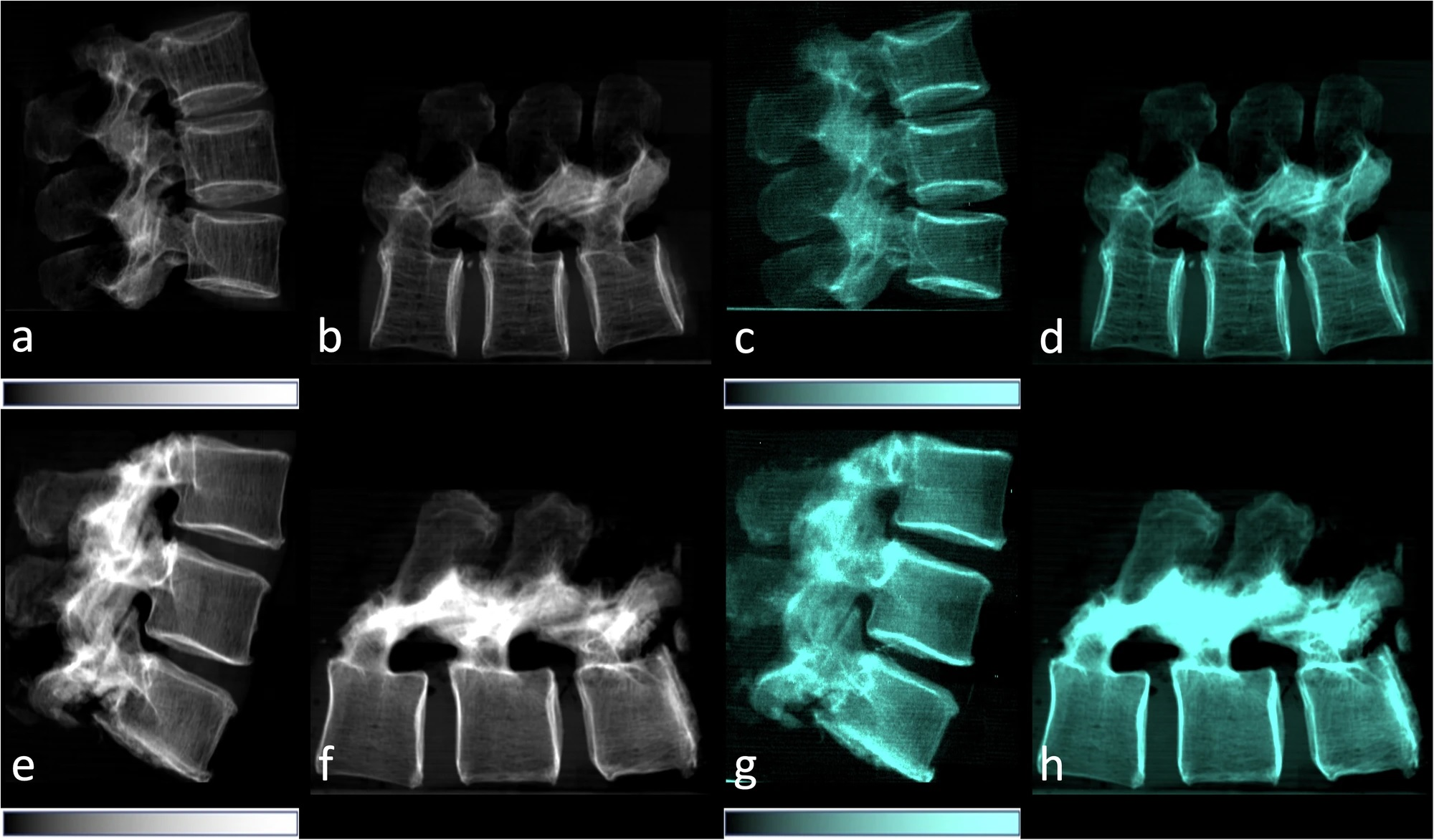 Dark-field x-ray detects bone changes related to osteoporosis ...
