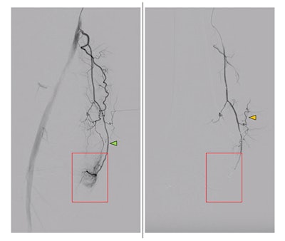 Peri-interventional digital subtraction angiography (DSA) of the descending genicular artery (DSA), a diagnostic procedure to view the inner surface of blood vessels, (green arrow) in a patient with symptomatic knee osteoarthritis of the right leg. On the left, the pre-interventional image with a clearly visible hyperemic blush (red box). On the right, the post-interventional DSA after embolization with Imepenem-Cilastatin. A completely eliminated blush is observed while preserving skin collaterals (orange arrows). Image courtesy of the RSNA.