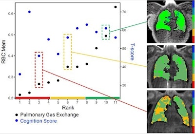 Individuals in the study were plotted with the x-axis being rank of pulmonary gas exchange. The black dots show the pulmonary gas exchange ratio (red blood cell to tissue plasma ratio, RBC:mem) on the left y-axis and the blue dots are the cognition scores on the right y-axis. Gas exchange maps of three representative patients from a low, medium, and high pulmonary gas exchange. Image courtesy of RSNA.