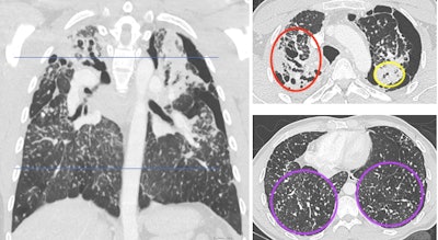 Contrast-enhanced chest CT shows upper predominant fibrosis/lung scarring (red oval), solid masses adjacent to a left-sided pneumothorax (yellow oval) and diffuse silicotic nodules (purple circle). This patient had a history of working in the countertop-cutting industry (15 years), smoking cigarettes (10 pack years), and active tuberculosis (treated 7 years prior and excluded at the time of this image with laboratory testing). Image courtesy of the RSNA.