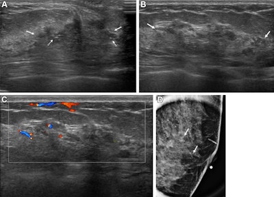 Images depict a 43-year-old woman with a malignant nonmass lesion that was diagnosed as microinvasive ductal carcinoma. (A) Transverse and (B) longitudinal ultrasound images show a hypoechoic nonmass lesion (solid arrows) with segmental distribution in the left breast. The lesion has associated calcifications (dashed arrows in A). (C) Longitudinal color Doppler ultrasound image shows high vascularity. (D) Magnified image in the mediolateral oblique view from screening mammography shows grouped calcifications (arrows), which are considered a mammographic correlate of the ultrasound-detected nonmass lesion (A radiopaque marker attached to the skin is visible in the image because the mammographic exam was performed after screening breast ultrasound). Ultrasound-guided core needle biopsy and pathologic examination revealed ductal carcinoma in situ, but the lesion was upgraded to microinvasive ductal carcinoma at subsequent surgery (2.5-cm ductal carcinoma in situ, histologic grade II, estrogen receptor-positive, progesterone receptor-positive, human epidermal growth factor receptor type 2-negative).
