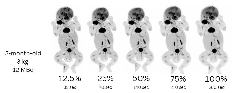 A significant cut in pediatric radiation dose is feasible in F-18 FDG long axial field-of-view PET/CT. Courtesy of the Nuclear Medicine and Molecular Imaging Department of the UMCG and EANM.