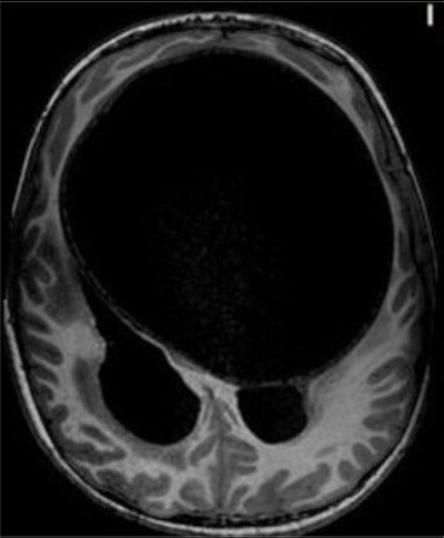 An axial T1-weighted MRI scan of a hydatid cyst. Clinical images courtesy of Dr. Carlos F. Ugas Chacape.