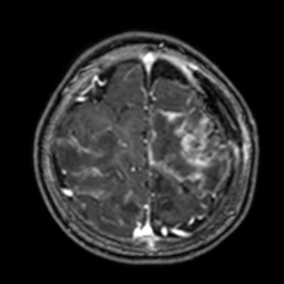 Contrast-enhanced T1-weighted MRI scan shows multiple abscesses due to free-living amebiasis (Balamuthia mandrillaris).