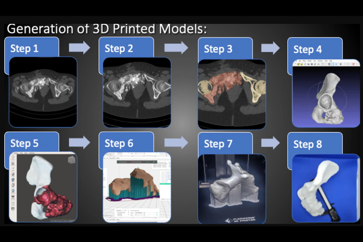 8 steps to create 3D printed models from CT scans | AuntMinnieEurope