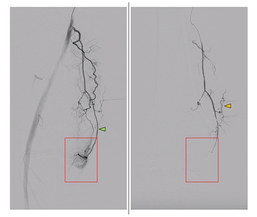Digital Subtraction Angiography Dsa Gae 673f5b7c2c15d