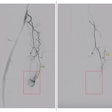 Digital Subtraction Angiography Dsa Gae 673f5b7c2c15d