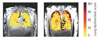 Lung function MRI showing problem areas (measurement levels of dysfunction) in lung transplant recipients.