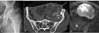 Clear cell chondrosarcoma can be seen in the left femoral head (arrow in a), and chondrosarcoma is visible in the left ilium (arrow in b and c). All figures courtesy of Dr. Rajesh Botchu.