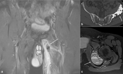 Figure shows left adductor tear (arrow in a), melorheostosis of left ilium (arrow in b), aneurysmal bone cyst in the left ischium (arrow in c).