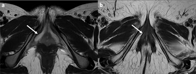 High-resolution axial T2 images show the clitoris (white arrows) of a 16-year-old post- pubertal woman (a) and a 73-year-old post-menopausal woman (b). In the younger woman, the clitoris is prominent and has a higher signal in T2 weighted images (WI); in the older woman, it is reduced in volume and has a lower signal in T2WI.
