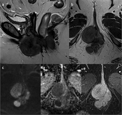 A 48-year-old woman who had already undergone a hysterectomy for multiple leiomyomas, presented with palpable masses at the level of the left labia minora and vagina. MRI shows multiple oval and round, well-defined masses at the level of the vulva, vagina, perianal, and perirectal. These lesions show hypointense signal intensity on sagittal (a) and axial (b) T2WI, with diffusion restriction on high b-value diffusion-weighted imaging (c) and ADC map (d), and homogeneous late enhancement in axial post-contrast fat-saturated T1WI (e). The final histologic diagnosis was extrauterine leiomyomas.