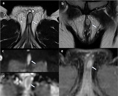 A 37-year-old woman presented with a nodule above the clitoris that was slow-growing for 10 years but which had recently become painful. Axial (a) and coronal (b) T2WI show an oval, well-defined vulvar mass (white arrow) involving the clitoral glans without invasion of adjacent organs with a hyperintense, heterogeneous signal. The lesion presents diffusion restriction on DWI (c) and the corresponding ADC map (d). Axial contrast-enhanced axial fat-saturated T1WI shows heterogeneous enhancement (e). The lesion was removed surgically, and the final diagnosis was schwannoma. All images courtesy of Drs. P. Clauser, M. Dolciami, B. Gui et al and EJR.