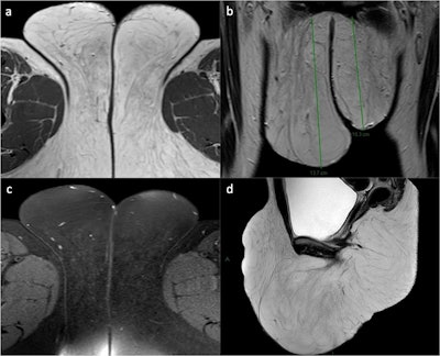 Childhood asymmetrical labium majus enlargement (CALME). A 30-year-old woman presented with hypertrophy of the external genitalia without skin alterations or symptoms. Axial (a), coronal (b), and sagittal (d) T2WI reveal hypertrophic subcutaneous adipose tissue (both superficial and deep) in the vulvar area, particularly at the level of the mons pubis and the labia majora (right > left). Axial fat-saturated T2WI (c) confirms adipose hypertrophy without signs of heteroplastic tissue or lymphoedema. The final diagnosis was late-onset CALME.